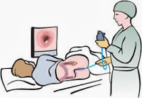colonoscopy screening