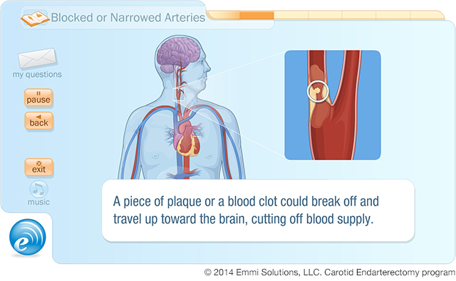 Emmi Solutions Interactive Carotid