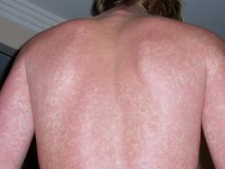 rash caused by drug