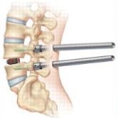 percutaneous spine