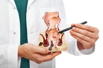 Hemorrhoids