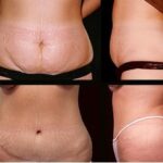Abdominoplasty is a cosmetic operation that is...