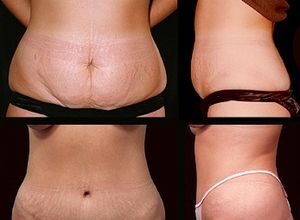 Abdominoplasty is a cosmetic operation that is...