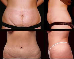 Abdominoplasty is a cosmetic operation that is...