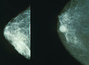  Mammograms Overdiagnose Breast Cancer – Let the Games Begin!