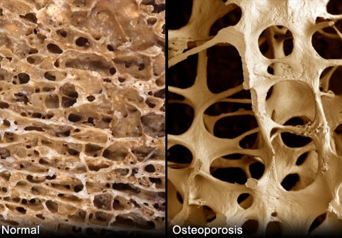 Osteoporosis - Marielaina Perrone DDS