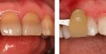 Teeth Whitening Tetracycline staining