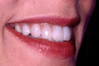 getting a veneer