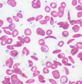 Sickle Cell Anemia peripheral blood smear