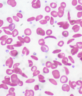  Sickle Cell Disease: New Take on Old Therapy