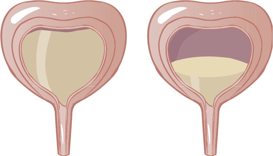 Полный мочевой пузырь почему. Гиперреактивный мочевой пузырь. Переполненный мочевой пузырь. Переполнение мочевого пузыря. Опорожнение мочевого пузыря.