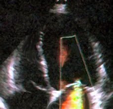 echocardiographic