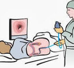 colonoscopy screening