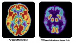  Alzheimer’s Disease Linked to Poor Sleep: Quantity and Quality of Sleep Make a Difference