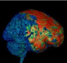 concussions