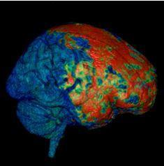  First-Ever Look Inside a Concussed Brain Reveals Porous Barriers