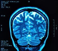 MRI brain scan
