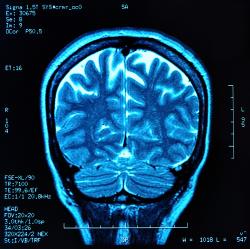 MRI brain scan