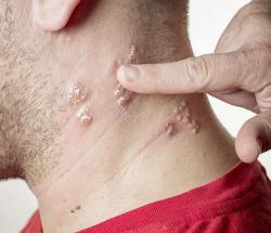 shingles vaccine and heart attacks, stroke