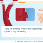 Emmi Solutions Instructional, Interactive Guide For Taking Warfarin