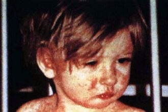 measles vaccine