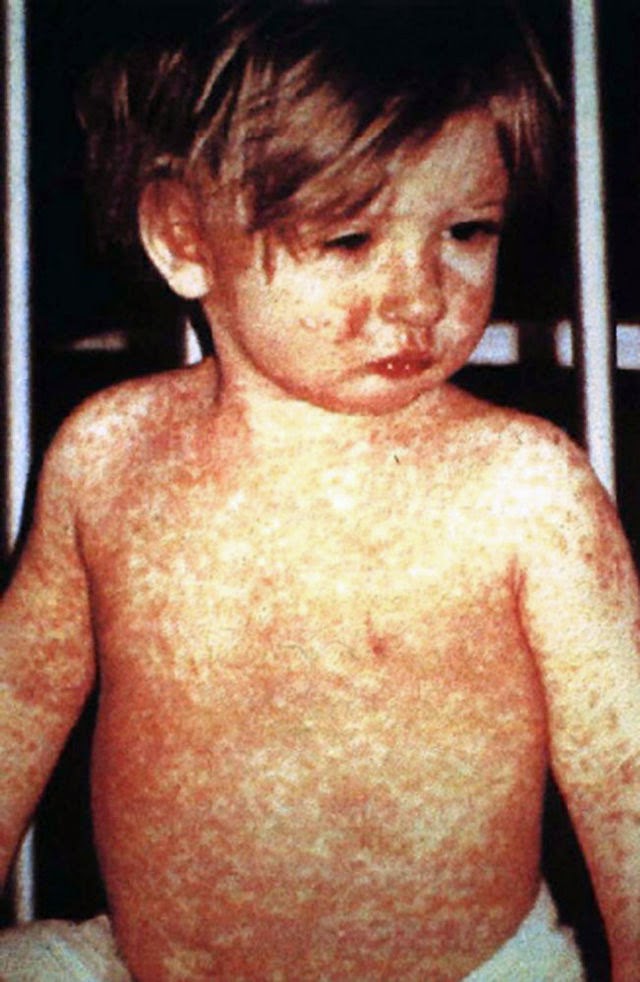  Measles Vaccine: A Right to Refuse Treatment