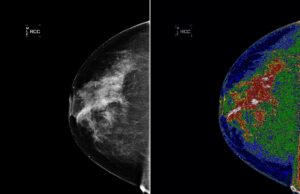  Breast cancer while uninsured: One woman’s story