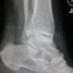 ImagingTechnologyNews December-2015 X-ray_Fractured_fibula_with_permission_of_patient_MF