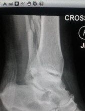 ImagingTechnologyNews December-2015 X-ray_Fractured_fibula_with_permission_of_patient_MF
