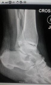 ImagingTechnologyNews December-2015 X-ray_Fractured_fibula_with_permission_of_patient_MF