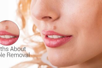 mole-removal