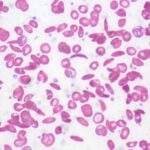 sickle cell anemia