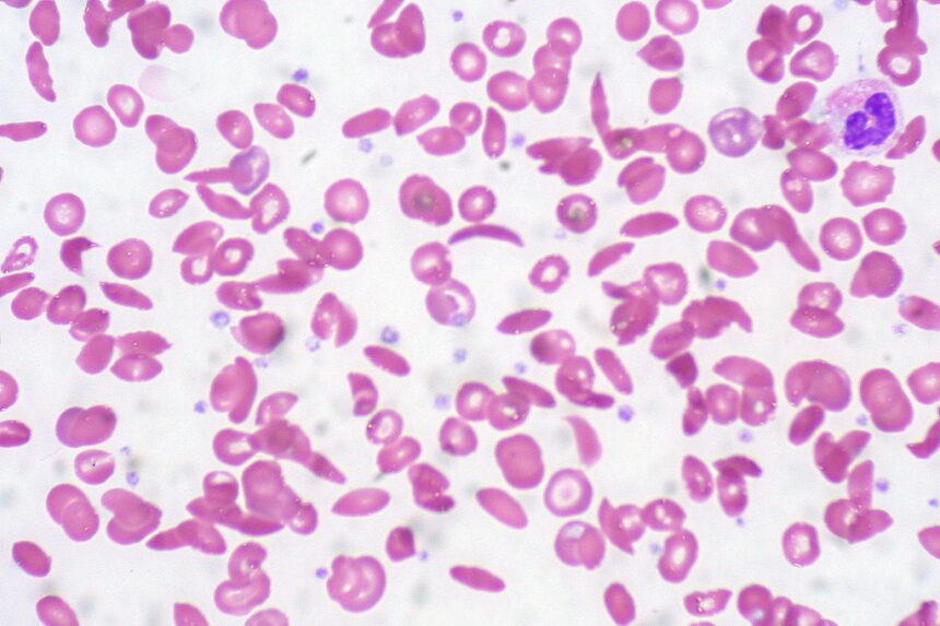 sickle cell anemia