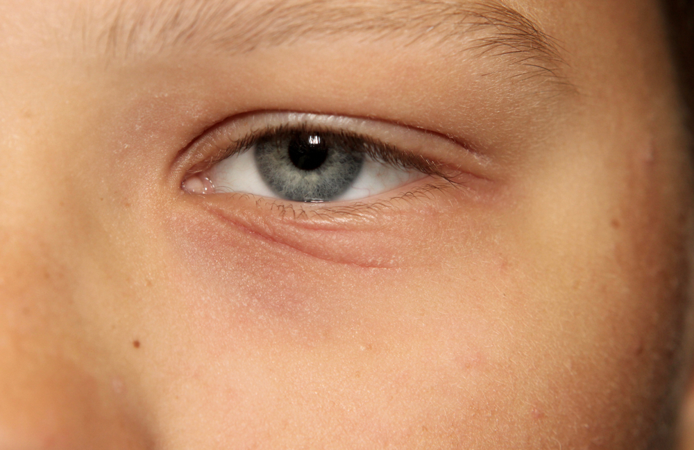 What are the common causes of Eyelid Eczema Health Works Collective