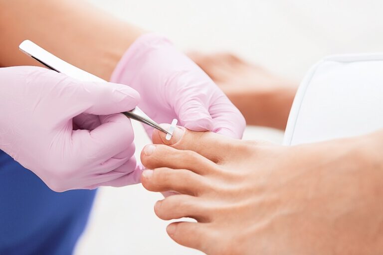 Finding Nearest Ingrown Toenail Clinic For Your Ingrown Toenail
