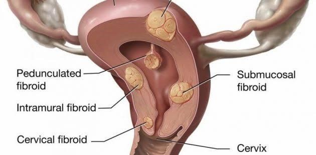  Advancements In Fibroid Treatment And Why It counts To Have Timely Professional Care