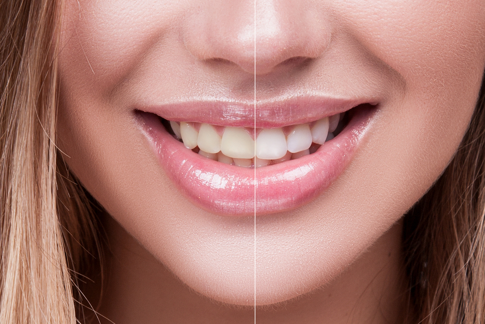 5 Reasons To Whiten Your Teeth At The Dentist In 2020