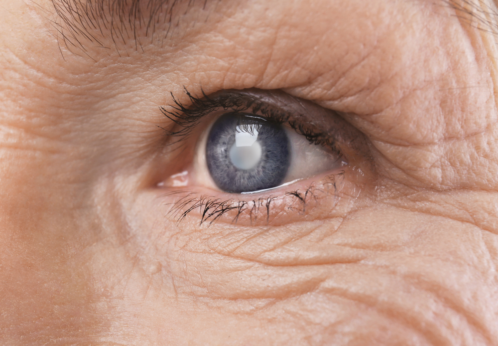  Your Helpful Guide To Recovering After Cataract Surgery