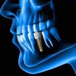 dental implant myths that must go away