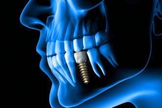 dental implant myths that must go away
