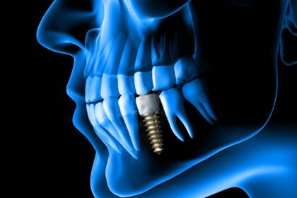 dental implant myths that must go away