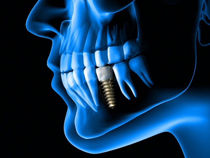 dental implant myths that must go away