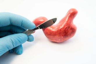 Gastric Band