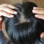 treat natural hair loss