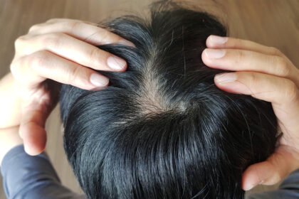 treat natural hair loss