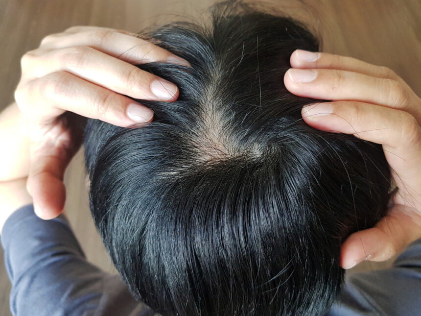 treat natural hair loss