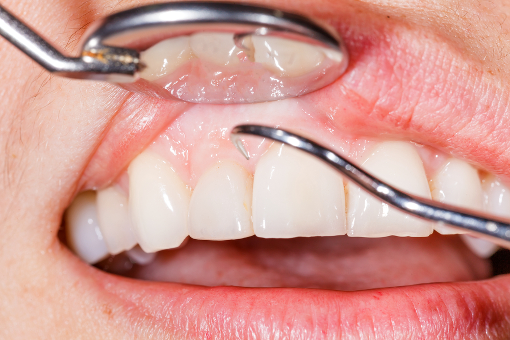 gum disease and other health risks