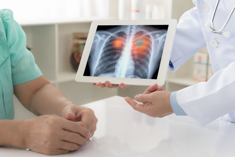 Advanced lung cancer diagnosis systems used by doctors