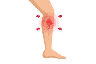 varicose veins