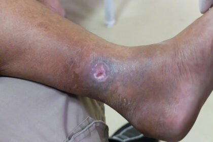 venous ulcer